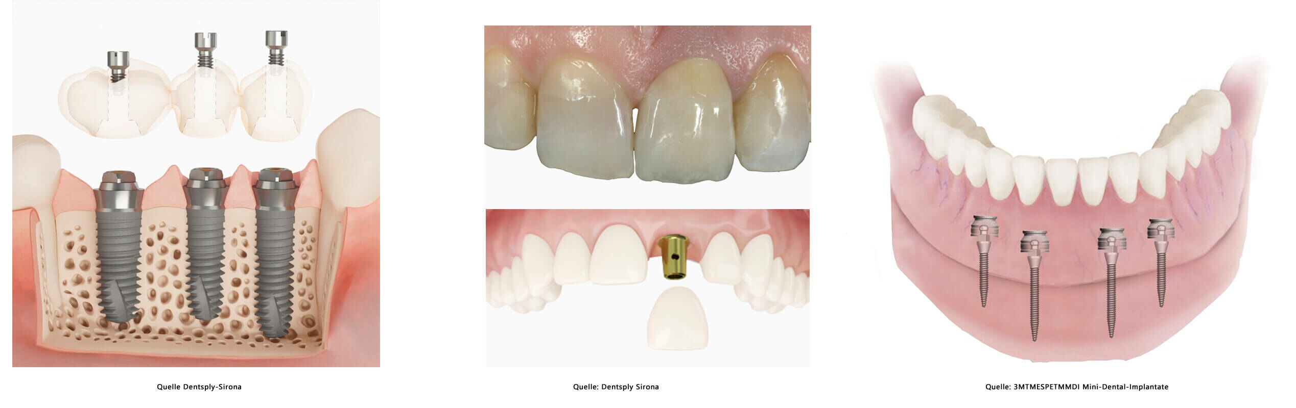 Zahnimplantatbehandlungen Dr. Gross