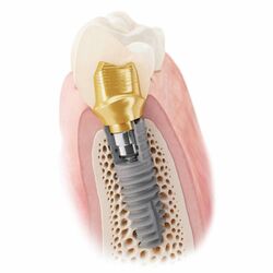 Zahnarzt Dr. Groß Implantologie_1